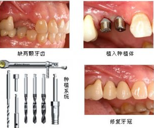 韩国登腾种植牙优缺点